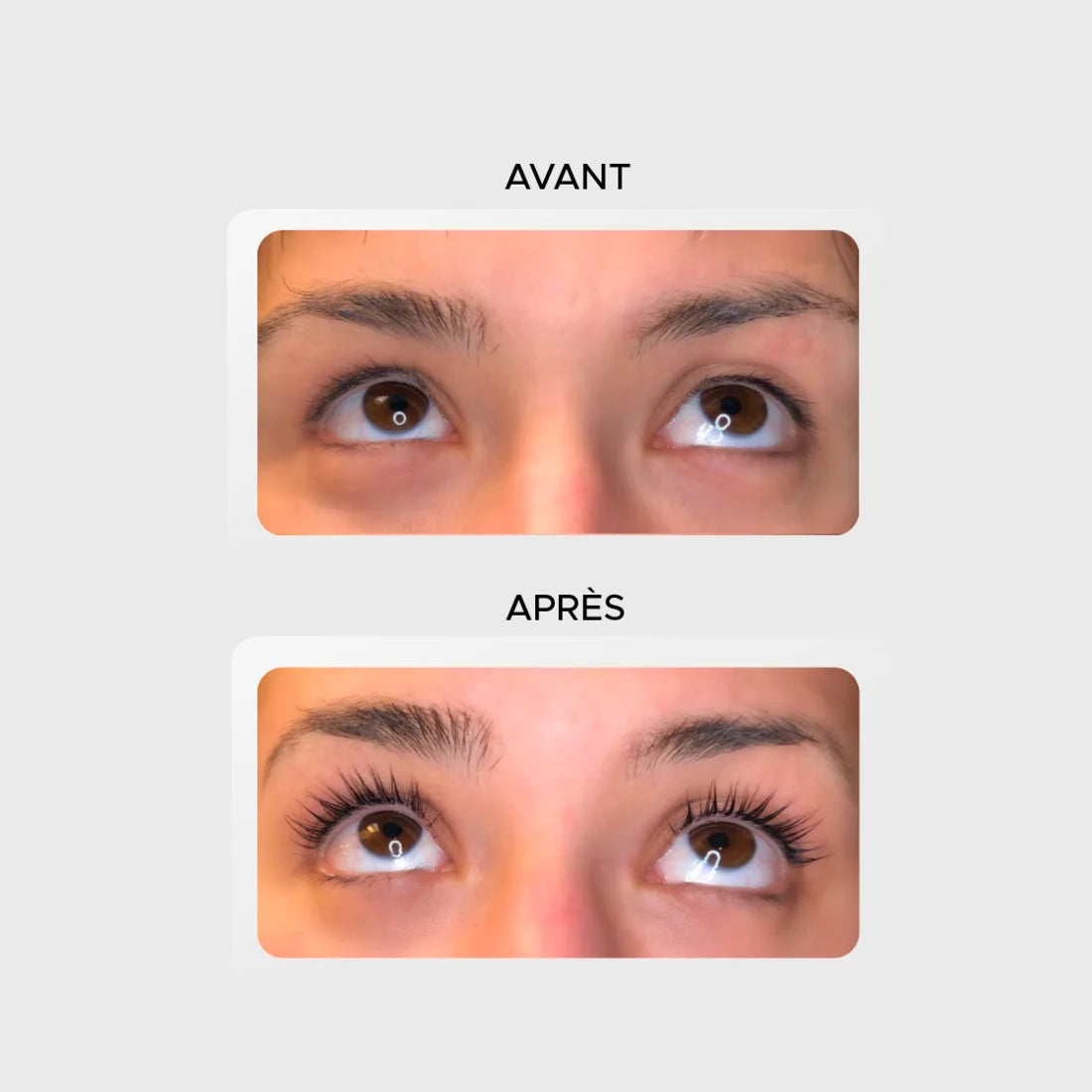 Avant / après — les deux yeux